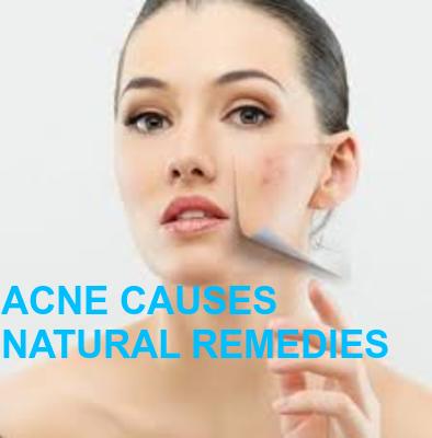 ACNE/PIMPLES CAUSES 10 BEST NATURAL REMEDIES